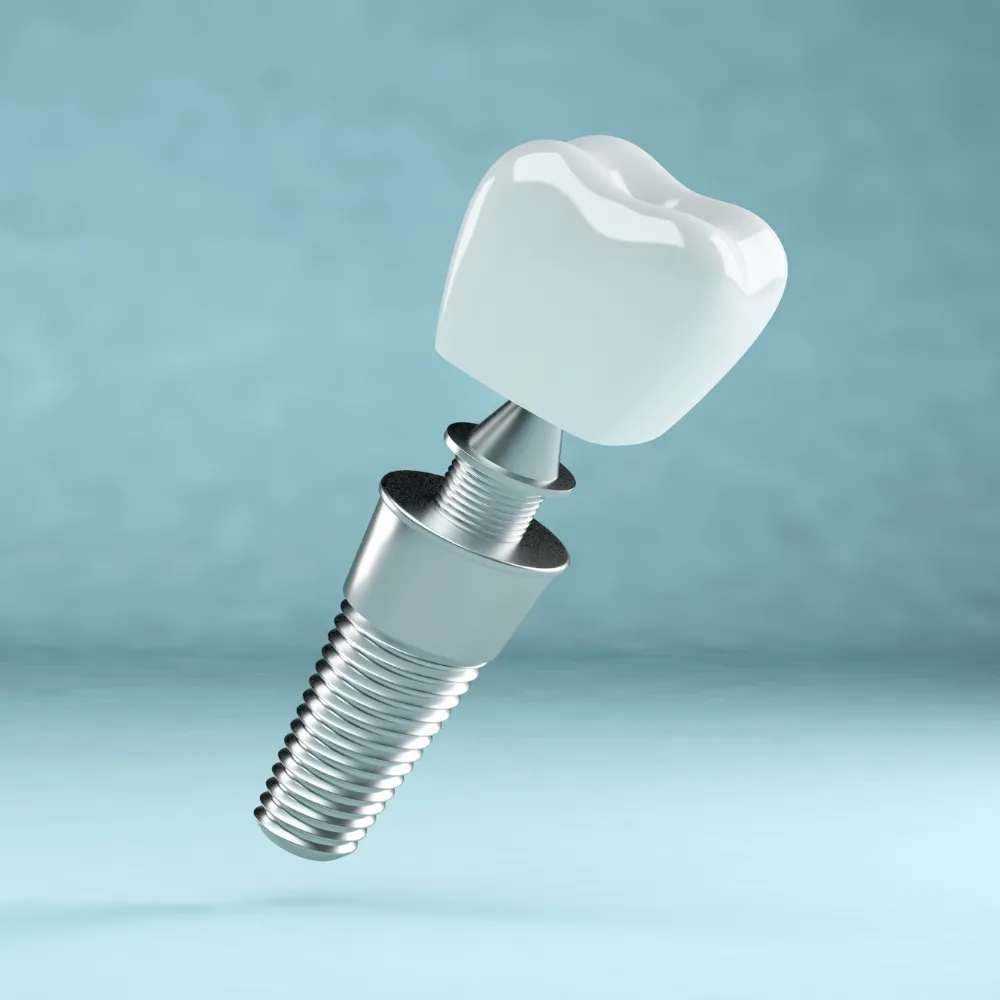 trong rang implant 8 11zon