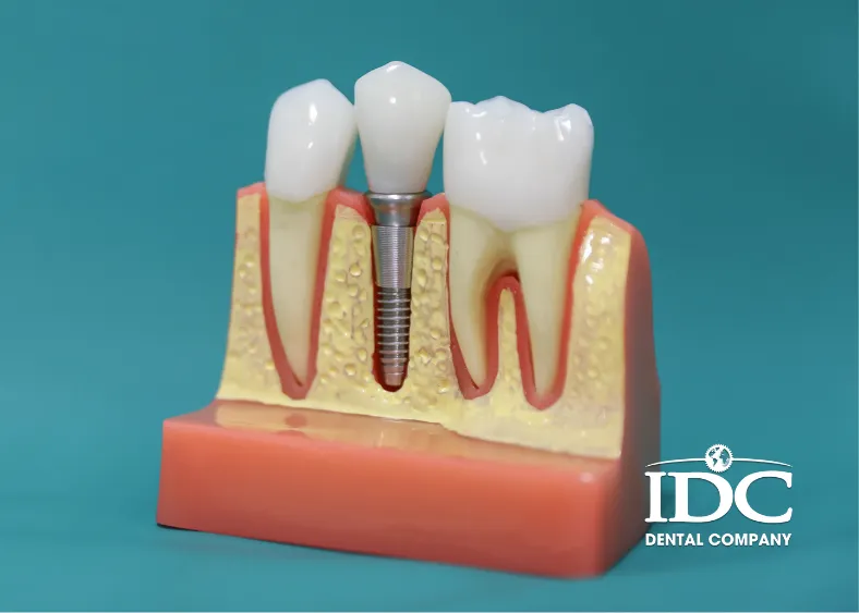 Có nên trồng răng implant không ?