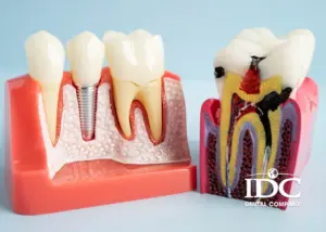 How Much Does Root Canal Treatment Cost in Da Nang City 2