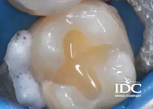 How Much Does a Cavity Filling Cost in Da Nang Vietnam 2 1