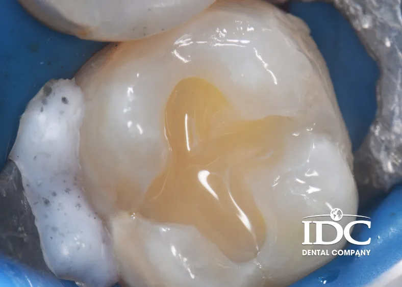 A Cavity Filling Cost in Da Nang, Vietnam