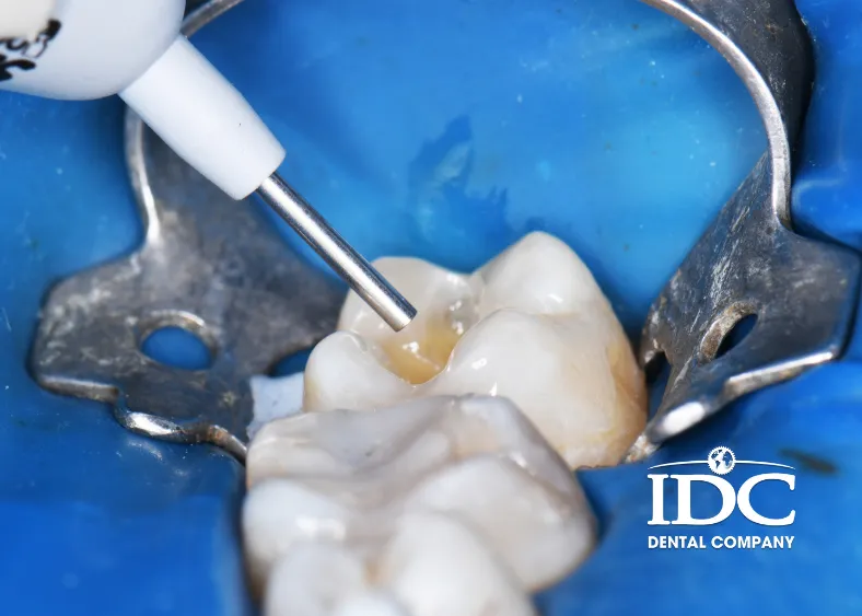 How Much Does a Cavity Filling Cost in Da Nang, Vietnam?