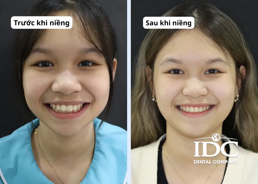 Khách niềng răng hô tại Nha khoa IDC Đà Nẵng