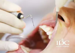 How Much Is the Cost of a Tooth Filling in Da Nang City, Vietnam?