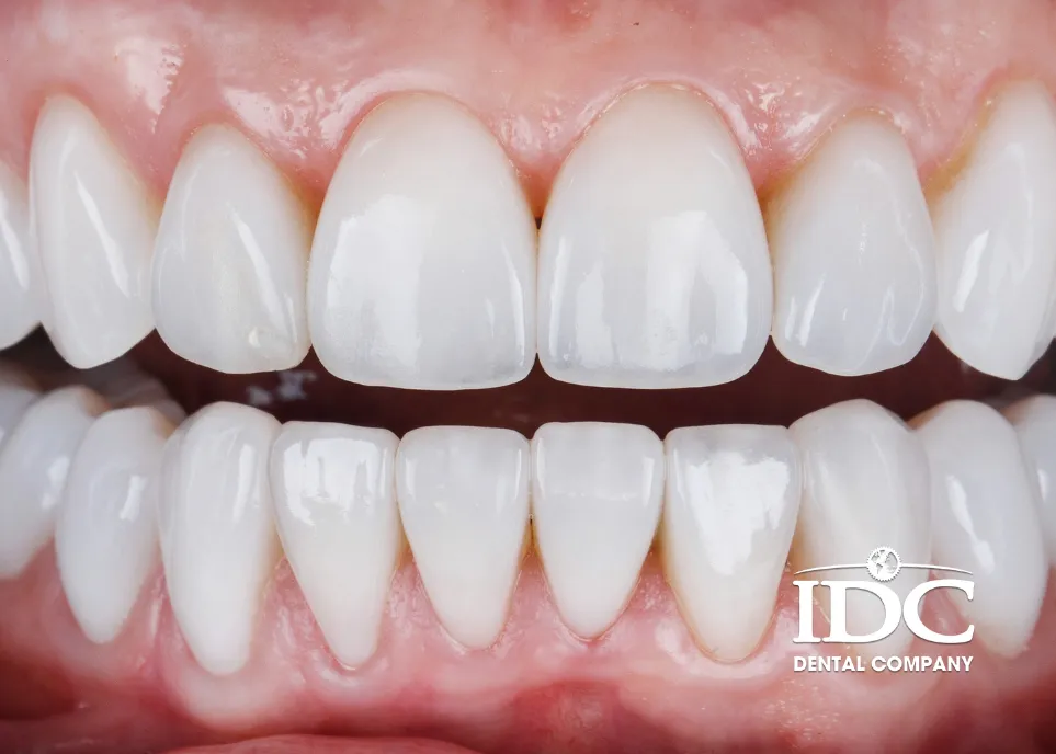 How Much Is the Cost of Porcelain Veneers in Da Nang City?