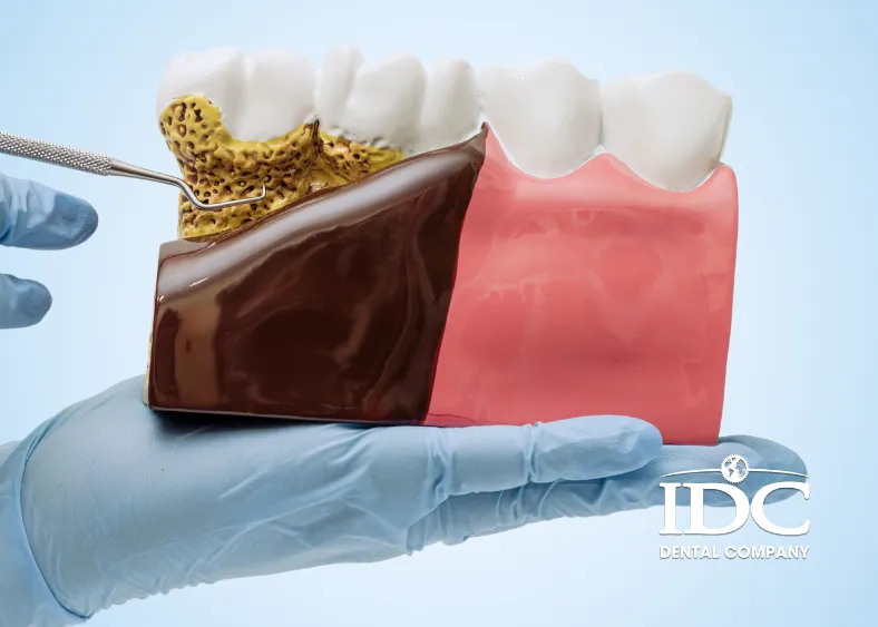 Moderate Signs of Periodontal Disease