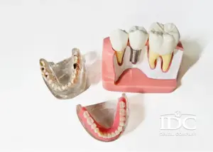 Top 10 Foods to Avoid After Dental Implant Surgery