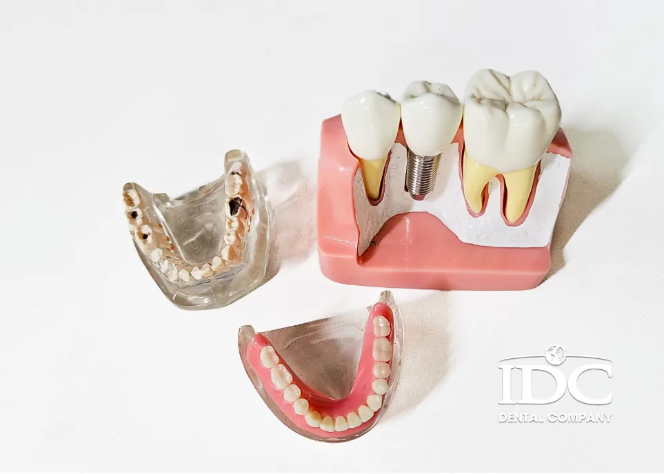 Foods to Avoid After Dental Implant Surgery 