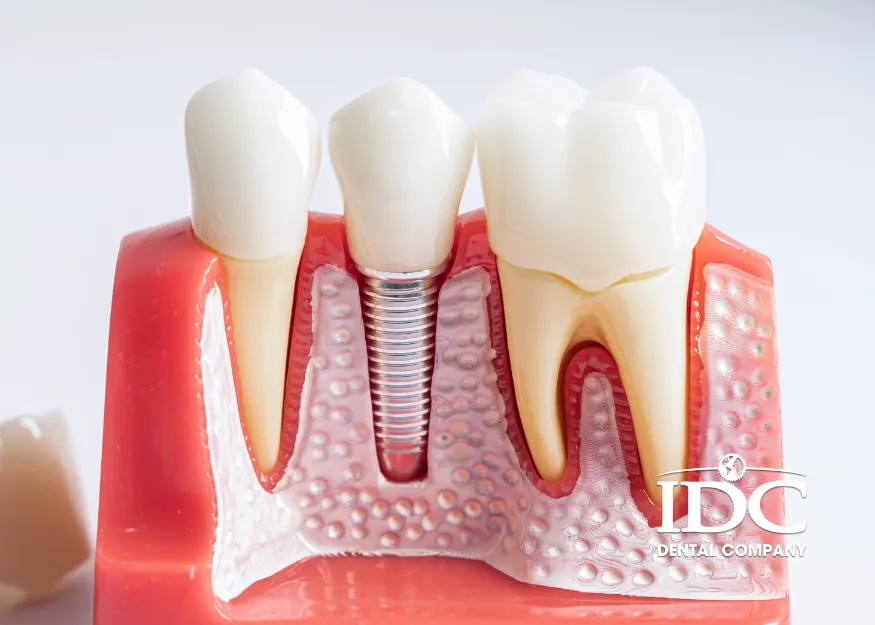 Bảng Giá Cấy Implant Chi Tiết Theo Từng Loại