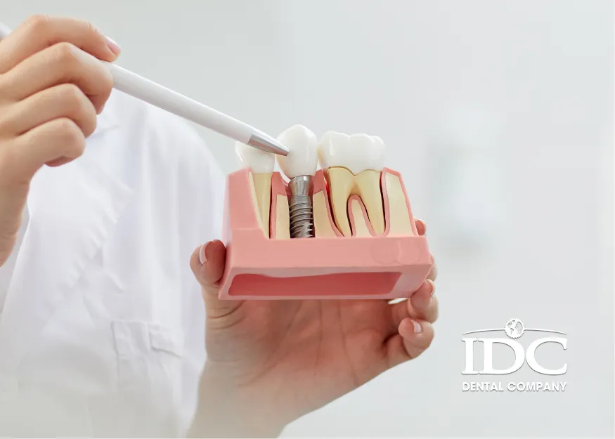 Chi phí cấy Implant bao gồm những gì?