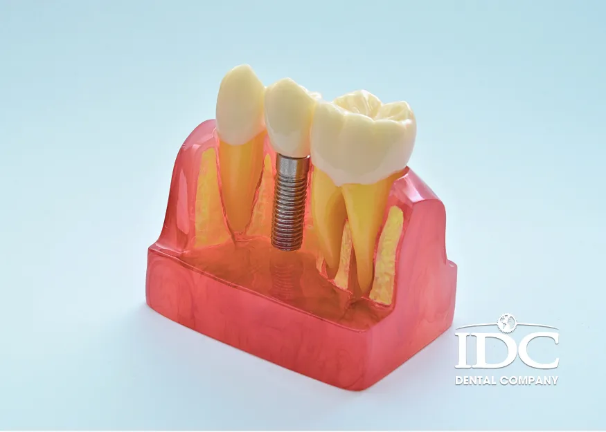Bảng giá cấy Implant chi tiết theo từng loại