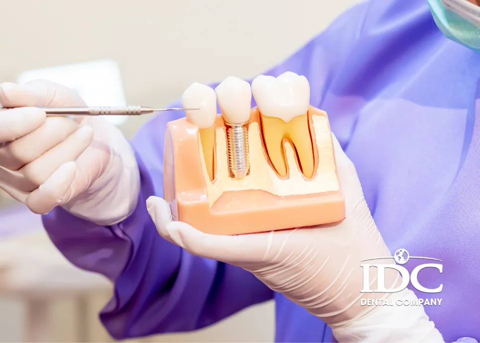 Bảng Giá Trồng Răng Implant Trọn Gói Tại Đà Nẵng Mới Nhất (2026)