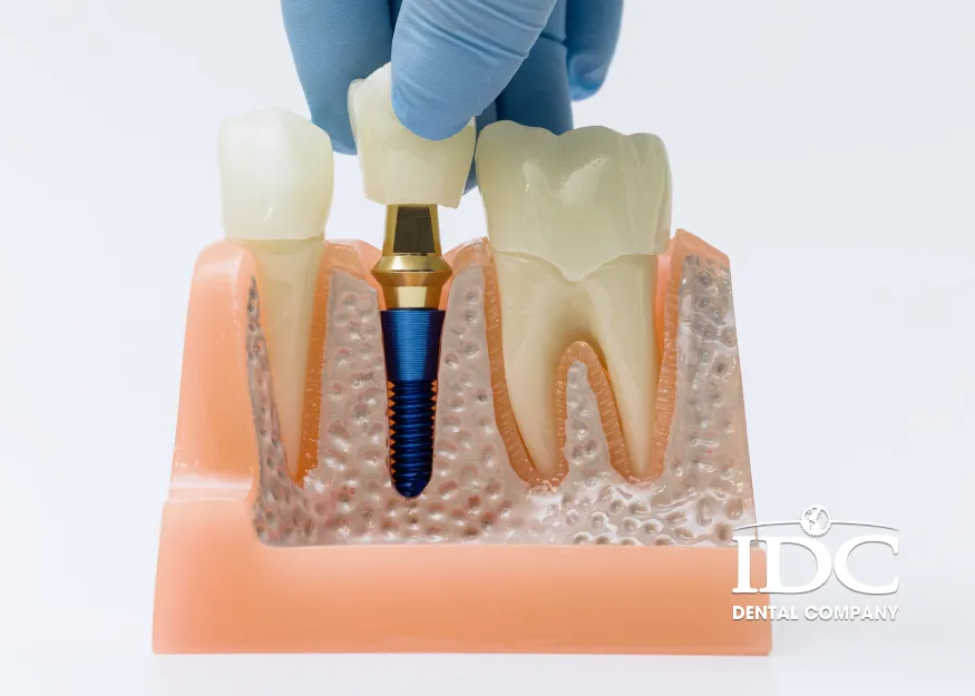 Cấy răng Implant có bền không khi sử dụng lâu dài?