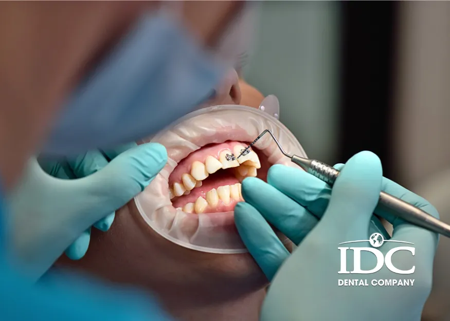 Niềng răng trọn gói bao gồm những gì?