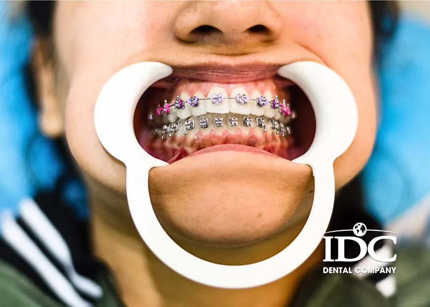 Niềng răng mắc cài