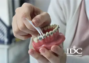 Các Quy Trình Niềng Răng Chuẩn Tại Nha Khoa IDC