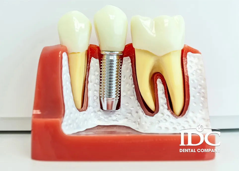 Chi phí nha khoa trồng răng tại Đà Nẵng