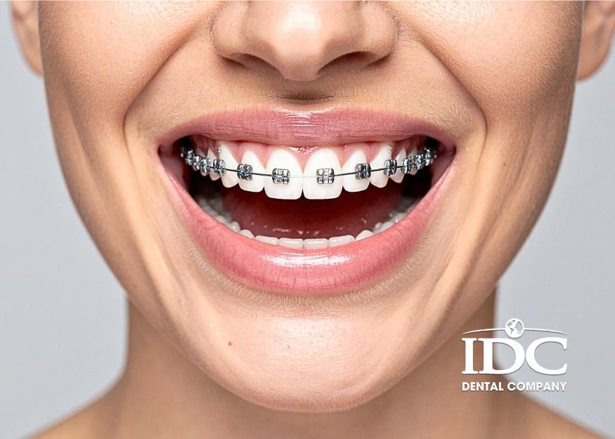 Quy trình niềng răng mắc cài kim loại
