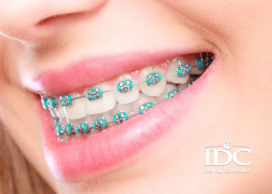 Niềng răng mắc cài kim loại truyền thống