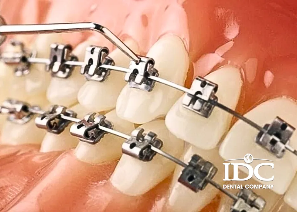 Niềng răng mắc cài tự buộc (tự động)