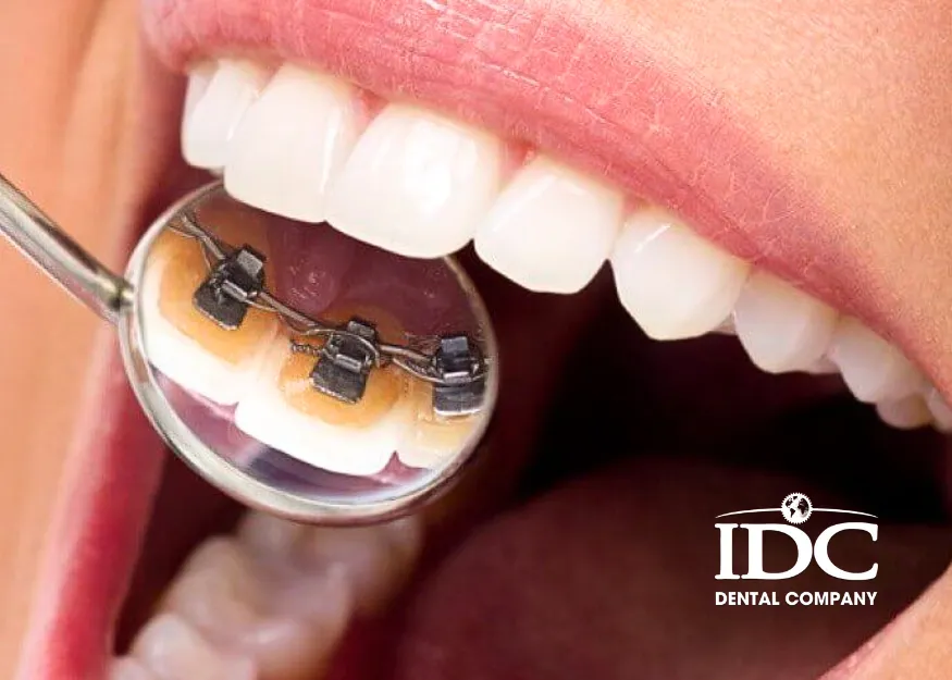 Niềng răng mặt trong (mắc cài mặt lưỡi)