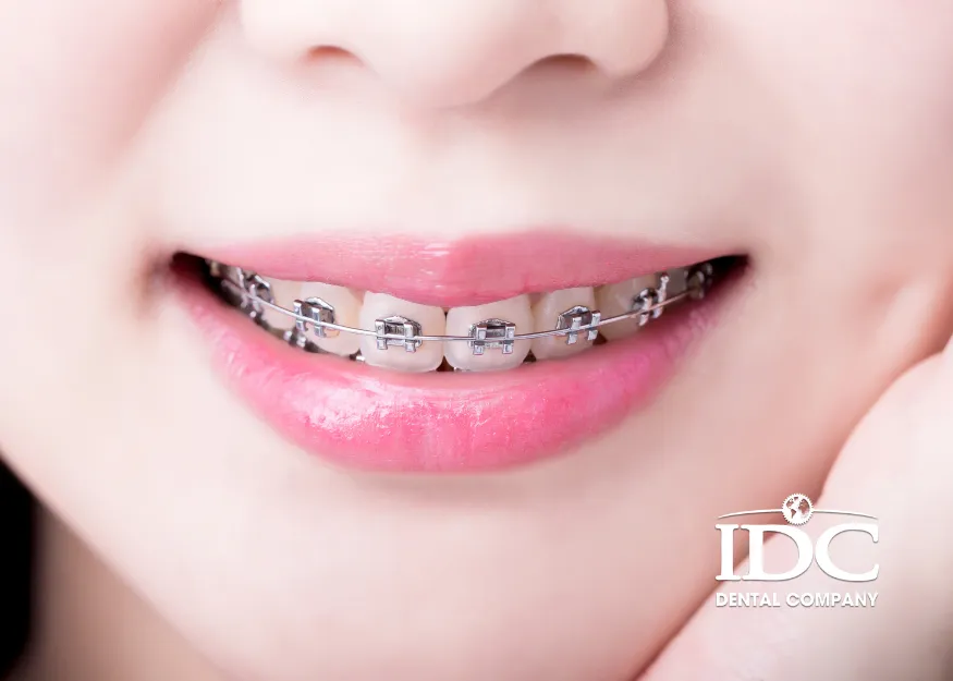 Các phương pháp niềng răng phổ biến hiện nay 