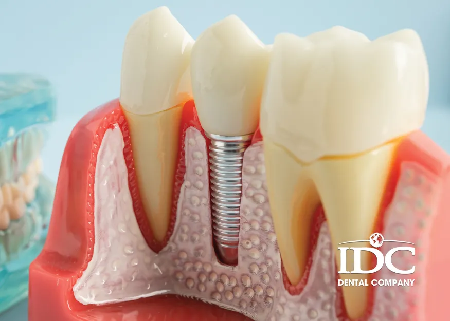 Quy trình cấy Implant chuẩn nha khoa diễn ra như thế nào?