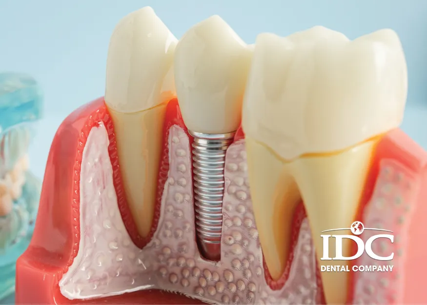 Quy Trình Cấy Ghép Implant Chuẩn Nha Khoa