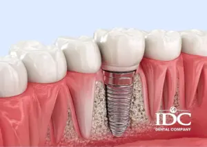 Răng Implant Có Tốt Không So Với Các Phương Pháp Khác?