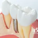 Thời Gian Trồng Răng Implant