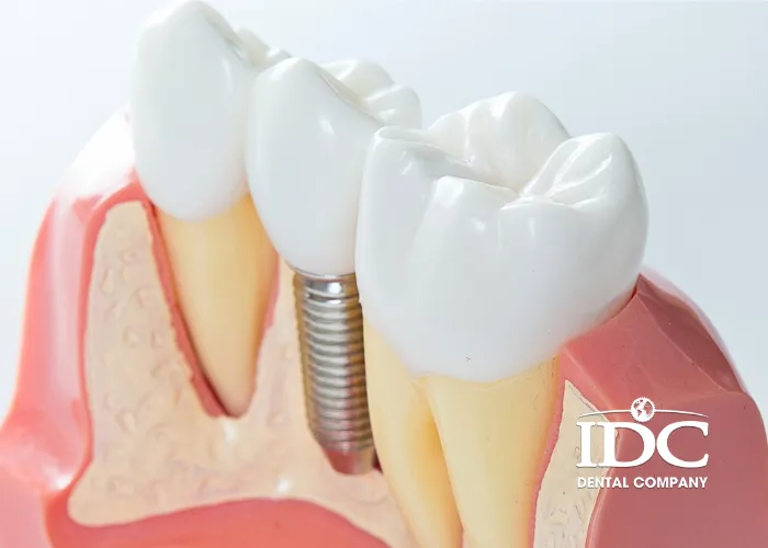 Thời Gian Trồng Răng Implant