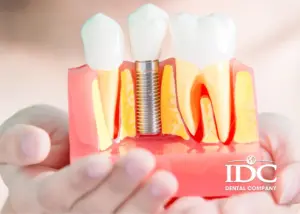 Bảng Giá Trồng Răng Implant Trọn Gói Tại Đà Nẵng Mới Nhất (2026)
