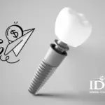 Chi Phí Trồng Implant Bao Nhiêu Tiền Cho 1 Răng?