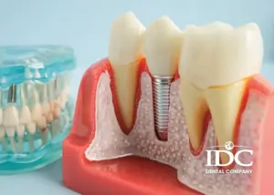 Trồng răng Implant giá rẻ có an toàn không?