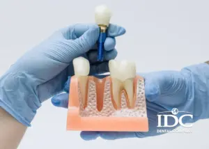 Trồng răng sứ Implant có gì khác răng sứ thông thường?