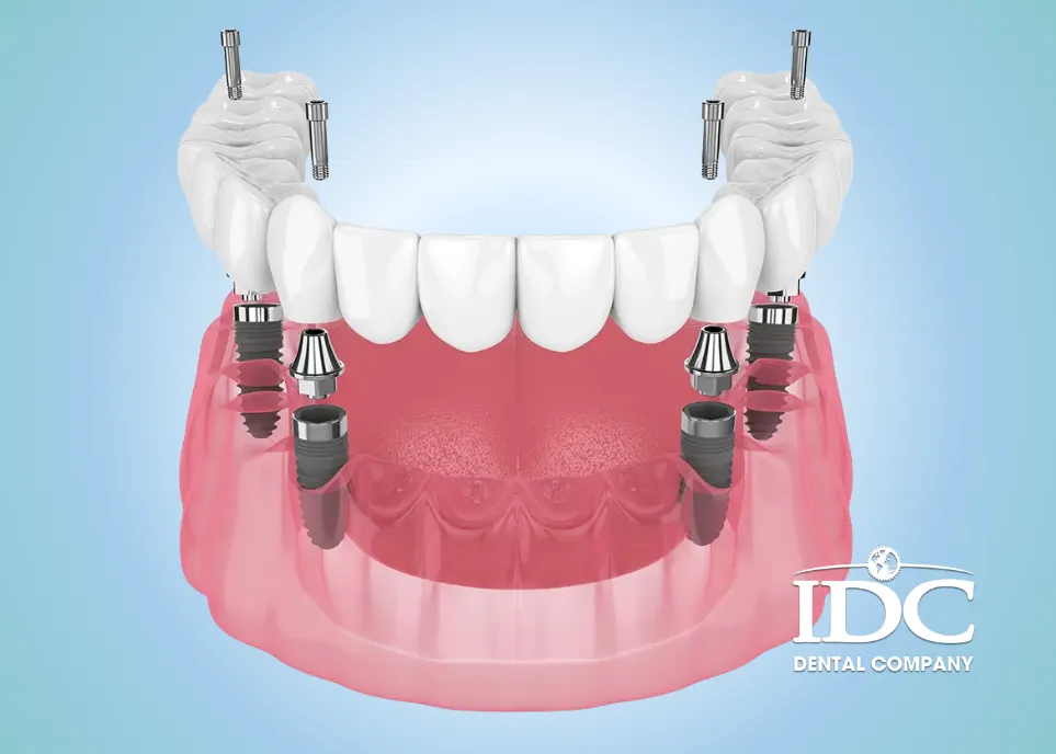 Key Benefits of All-on-4 Dental Implants
