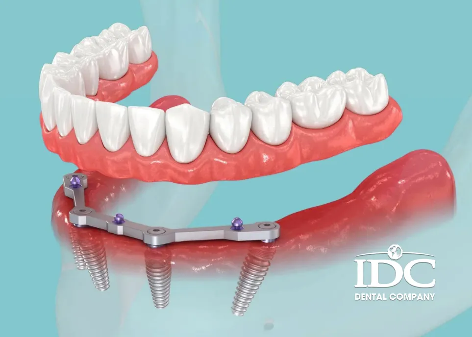 All-on-4 Dental Implants in Da Nang City, Vietnam