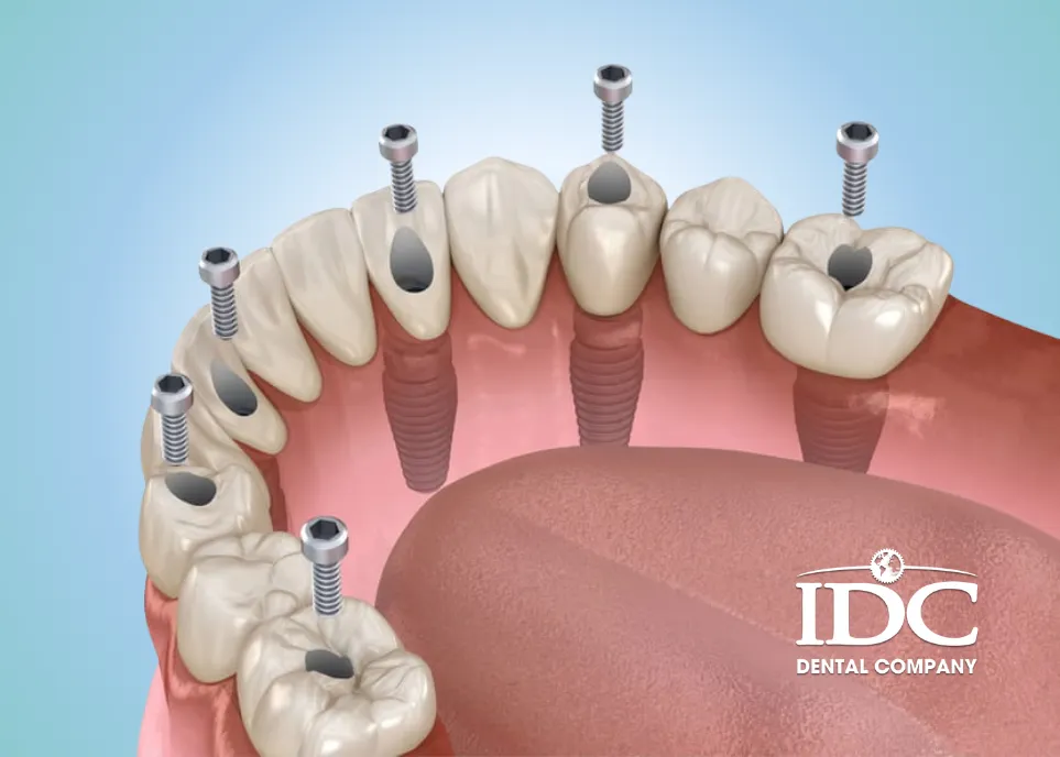 Benefits of All-on-6 Dental Implants