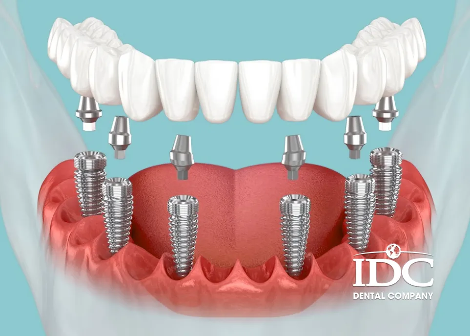 All-on-6 Dental Implants