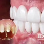 Boc rang su nguyen ham o Da Nang