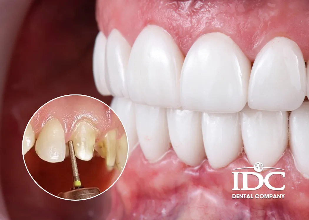 Boc rang su nguyen ham o Da Nang