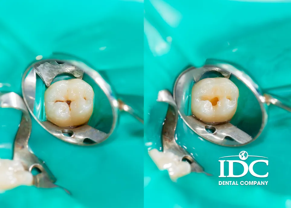 When Is Tooth Pain After a Filling Not Normal?