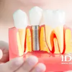 Nha Khoa trong rang implant