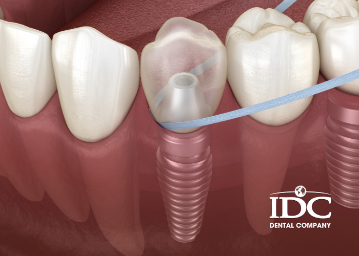 Trồng răng Implant toàn hàm áp dụng cho trường hợp nào?