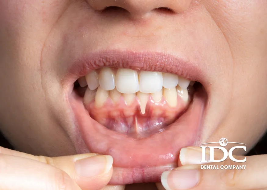 Early Symptoms of Gum Disease (Gingivitis)