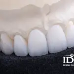 Where can I get same day dental crowns in Da Nang City 1