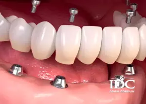 Where can I do a full-mouth dental makeover in Da Nang City?