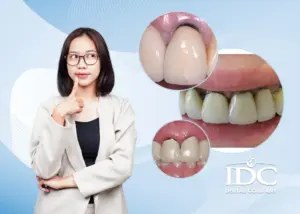 Làm răng sứ bị ê buốt nguyên nhân do đâu ? Cách nhận biết và khắc phụ hiệu quả