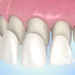 Bọc răng sứ bị thưa sau khi làm