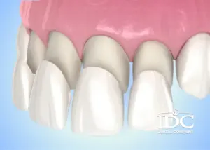 Bọc răng sứ bị viêm nướu có nguy hiểm không? Nguyên nhân và cách khắc phục